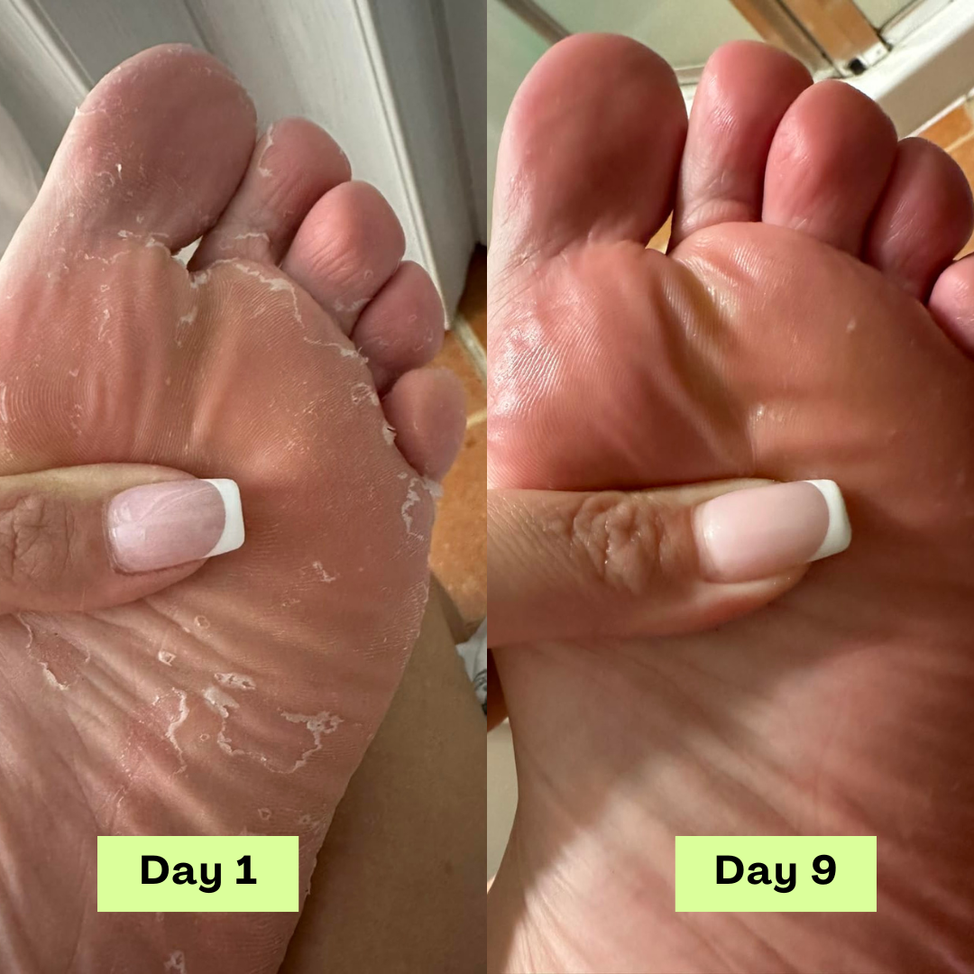 Loravey® AntiFungal Relief Soap Bar