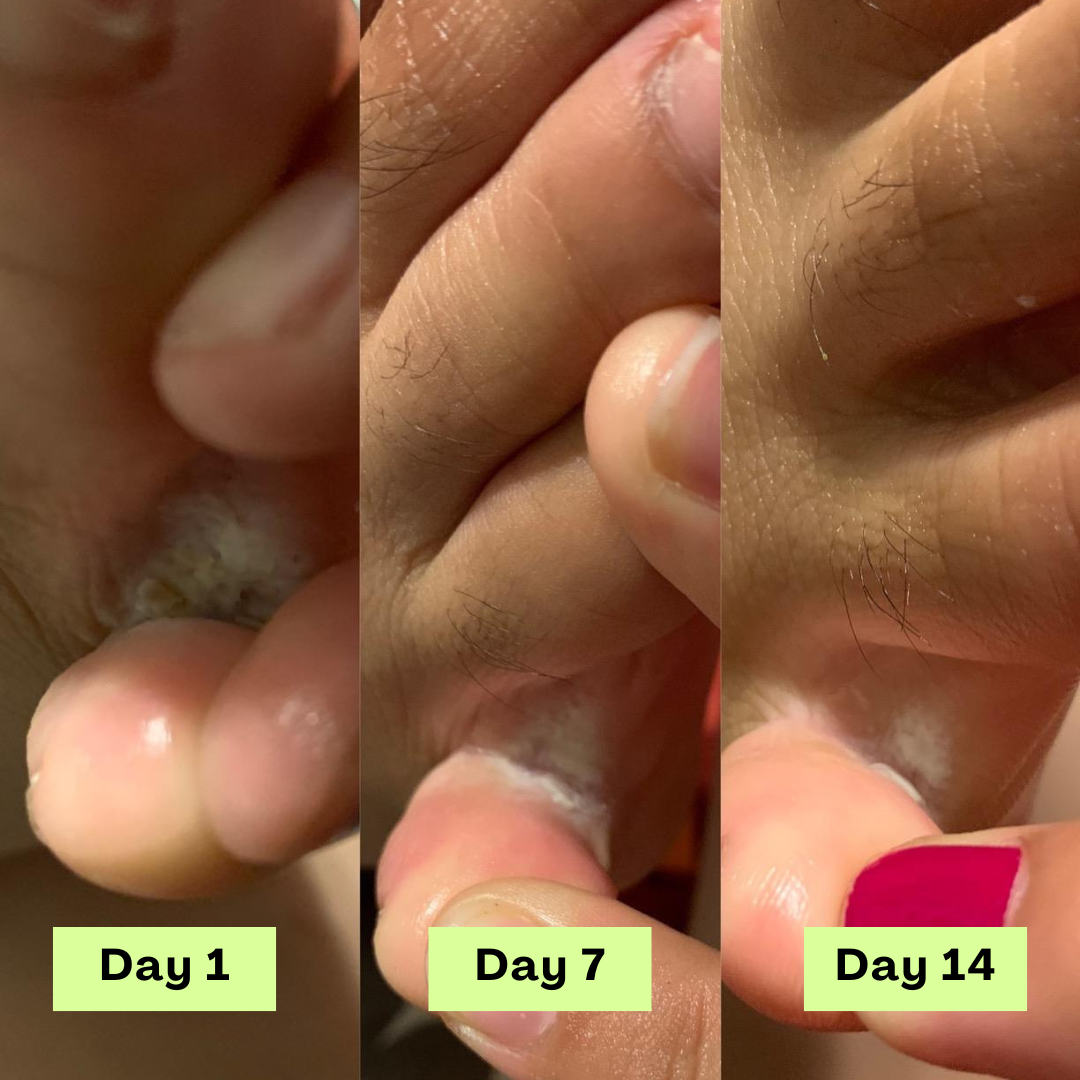 Loravey® AntiFungal Relief Soap Bar