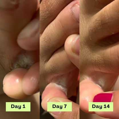 Loravey® AntiFungal Relief Soap Bar